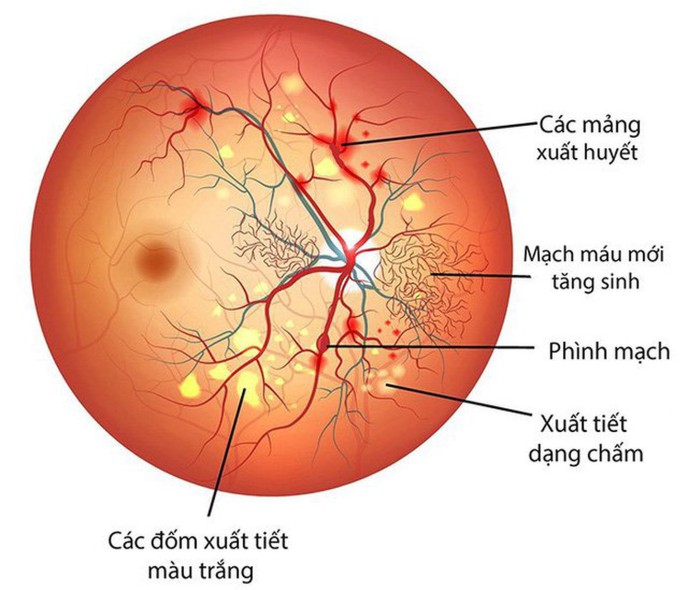 nguyen-nhan-va-cach-dieu-tri-benh-bong-vong-mac