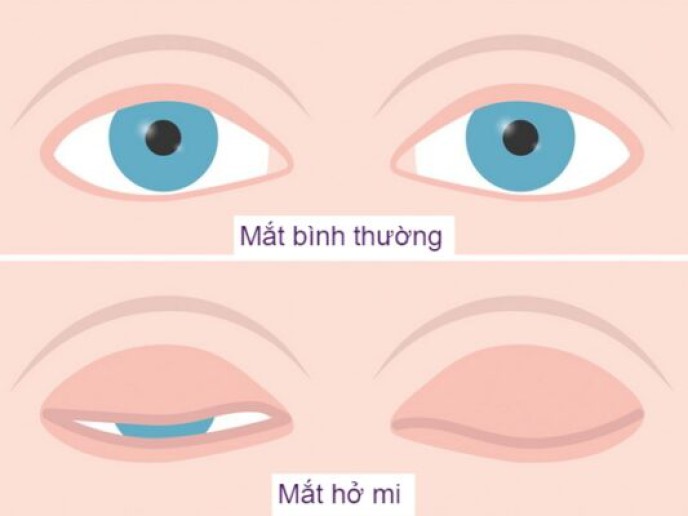 nguyen-nhan-va-cach-dieu-tri-ho-mi-mat