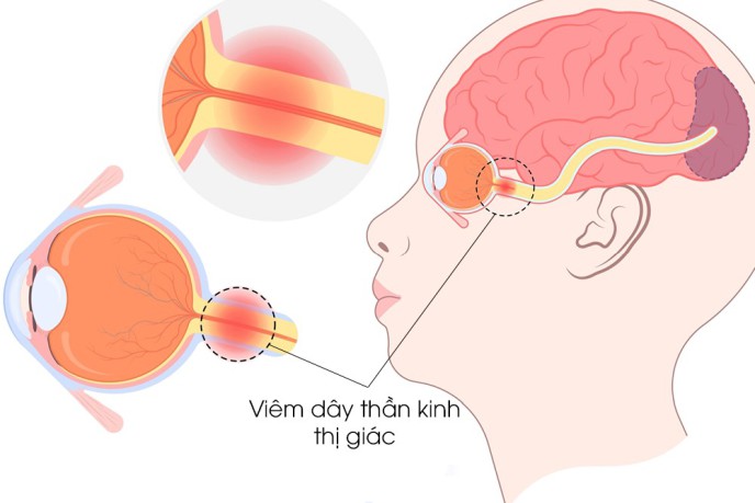 viem-day-than-kinh-thi-giac-co-nguy-hiem-khong