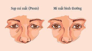 dieu-tri-sup-mi-mat