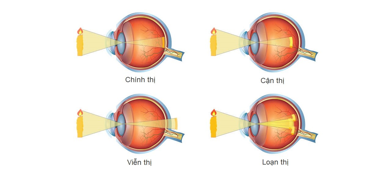 Hình ảnh mắt bị tật khúc xạ